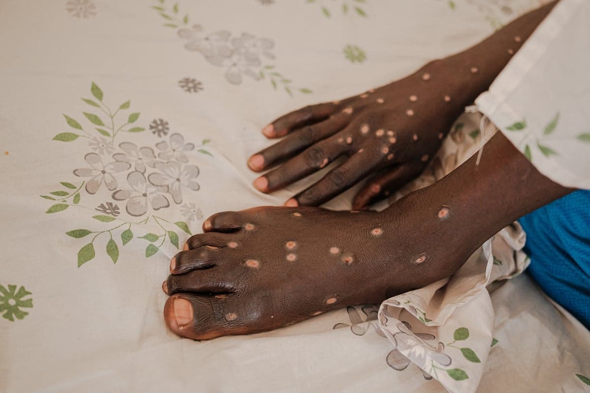 The foot and hand of an African man is seen with pink blisters highly visible against his skin