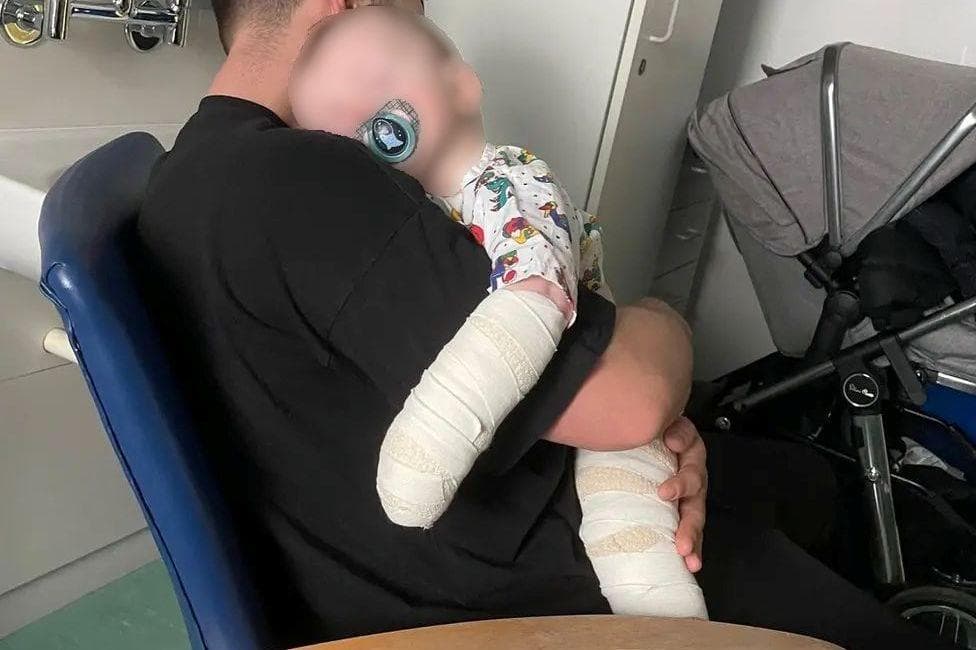 A baby being held by an adult, the baby has a bandaged arm and leg.