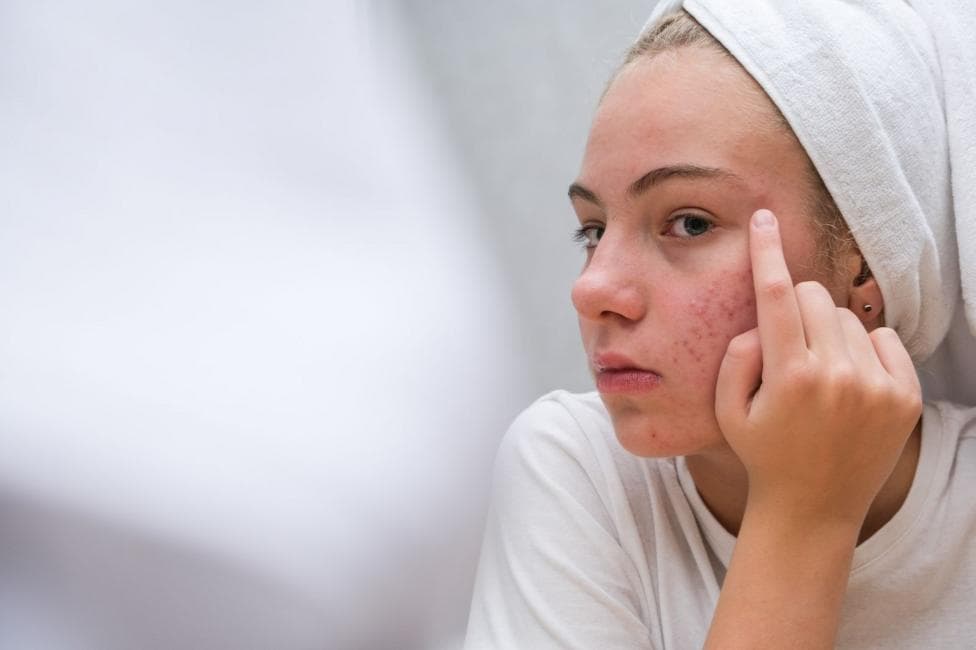 A young woman with acne touches her face. She is wearing a white T-shirt and has a white towel on her head