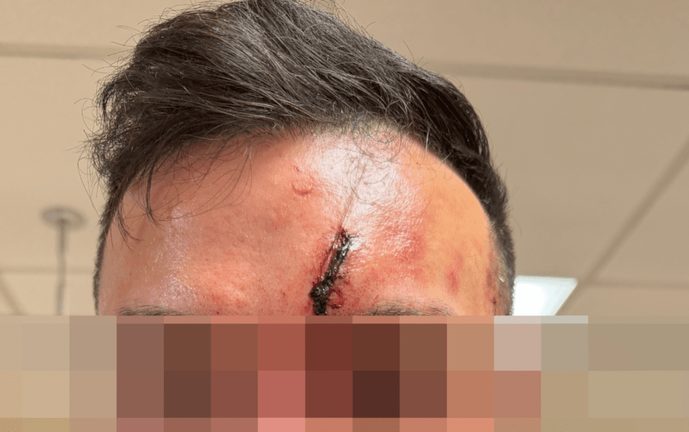 Hospial shot of bad head wound