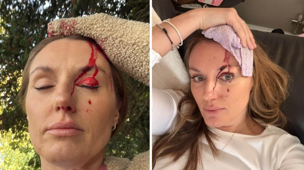 Two images of the same woman. In both, she has one hand on her head which is bleeding. In the left image, she has her eyes closed in a wooded area. In the right image, she is laid on a sofa.